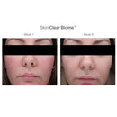 Skin Clear Biome & Skin Accumax