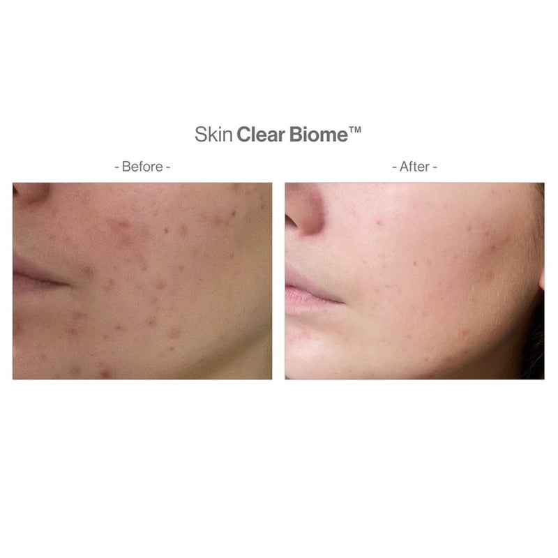 Skin Clear Biome & Skin Accumax