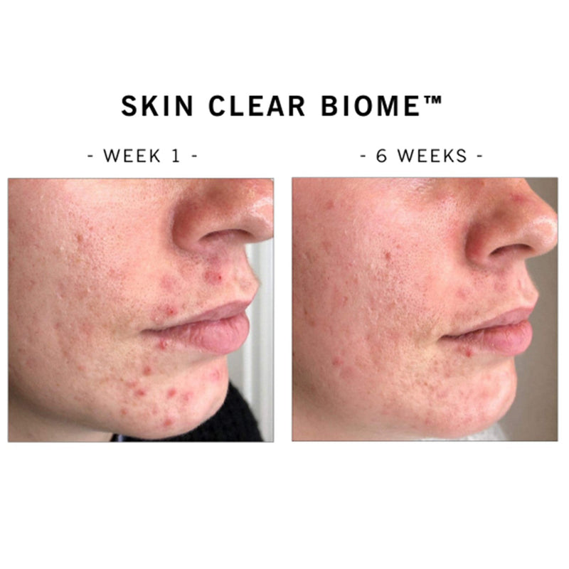 Skin Clear Biome & Skin Accumax