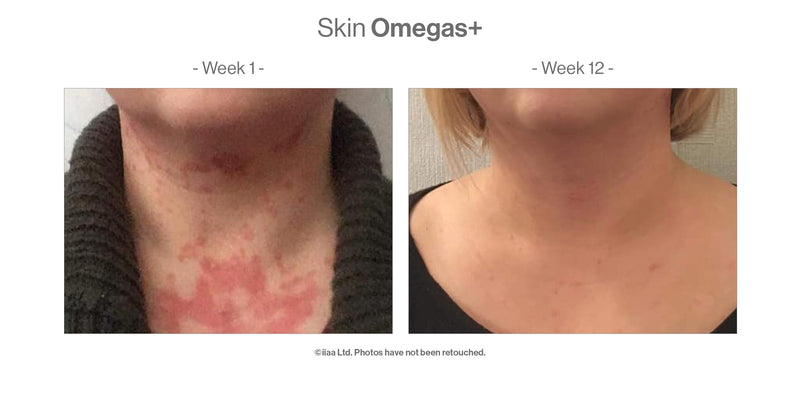水潤肌 Omegas+ 維 A 療程